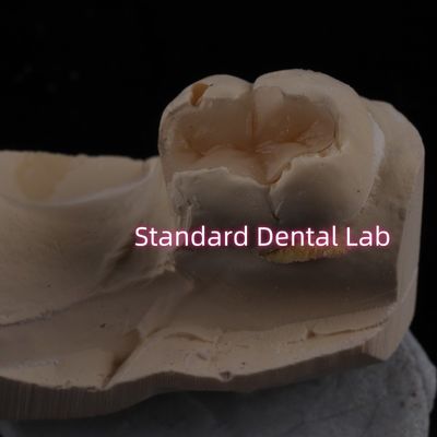 شراء طلاء الأسنان من البورسلين الصب على الطلاء الزركونيا Emax جمالية عالية التصنيع عبر الإنترنت