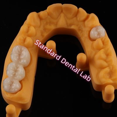شراء التاج جميع البورسلين السيراميك زيركونيا Ivoclar أسنان جمالية OEM التصنيع عبر الإنترنت