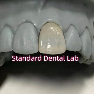 شراء طب الأسنان التجديدي إيماكس الأسنان الزركونيا التاج البورسلين التصنيع عبر الإنترنت