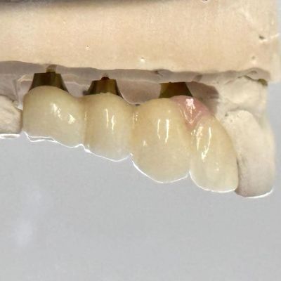 شراء البورسلين الزركونيا الاسمنتية المستمرة الزرع المسمار شكل الرأس الستة الأطراف لتناسب الجمالية المخصصة التصنيع عبر الإنترنت