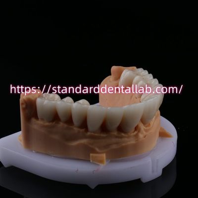 شراء FDA جمالية عالية الجسر الزركونيا الأسنان مع طبقات البورسلين زركونيا تاج الأسنان الصين مختبر الأسنان التصنيع عبر الإنترنت