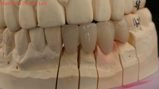 شراء تاجات المختبرات الأسنانية الصلبة 3D Pro عالية الشفافية تاجات الزركونية الكاملة مع ظل فيتا مخصصة التصنيع عبر الإنترنت