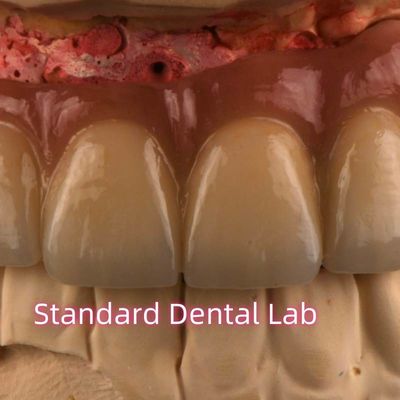 CAD CAM طحن PFM البورسلين غير الثمين المصبوب بالمعدن الجسر الثابت