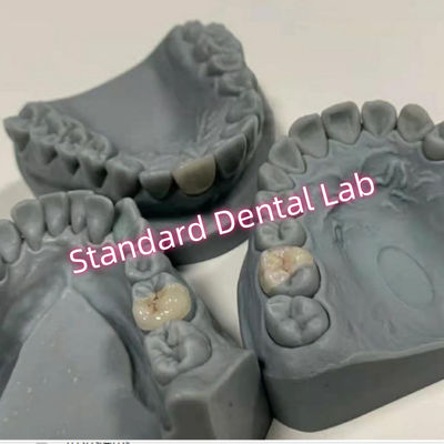 التجميل الطبيعي نظرة البورسلين المزروعات و المزروعات المغطاة