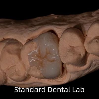 الشفافية Emax الزركونيا الأسنان المضمنة Onlay تاج لاستعادة شكل تجويف الطبيعي