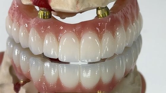 الأسنان كل شيء على X زرع PFM التاج التيتانيوم الثابتة العضلة الهجين