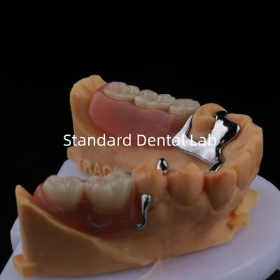 سبيكة معدنية جزء من إطار الأسنان 3 الشكل Exocad الطباعة بالليزر أسفل الصب الجزئي النهاية