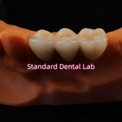 التاج الرقمي CAD CAM المختبر الأسنان الشفافة طبقة Zirconia التاج