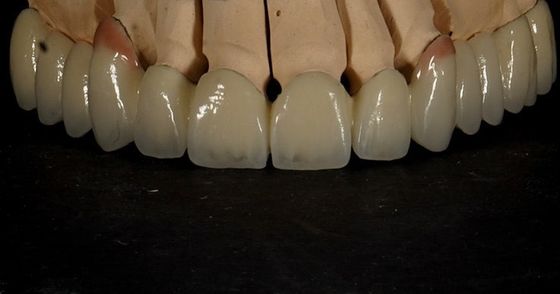 مناسبة جيدة جمالية جيدة زيركونيا متعددة الطبقات التاج البورسلين زيركونيا الجسر