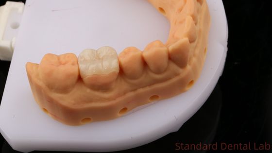 الشفافية الزركونيا طب الأسنان التجويف Onlay تاج لاستعادة شكل تجويف الطبيعي / مختبر الأسنان القياسية