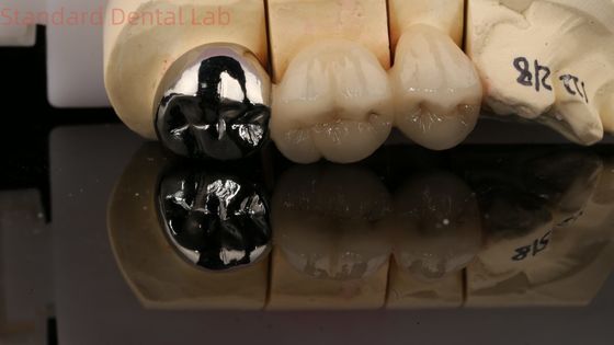 فيتا بورسيلاني تاج معدني كامل مع البريد النواة 3 سنوات ضمان من مختبر الأسنان
