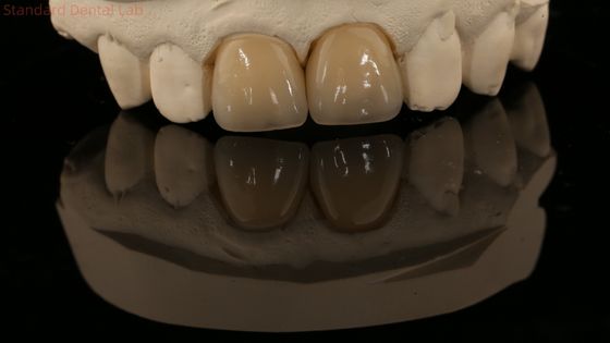تاج الزركونيا الكامل و جسر أسنان طبيعي عالي الجمال 5 سنوات ضمان